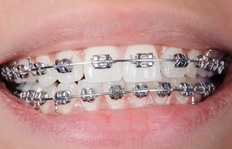 does medicare cover braces