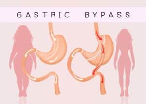 Does Medicare Cover Gastric Bypass Surgery