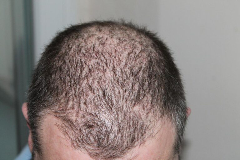Does Medicare Cover Hair Transplants?