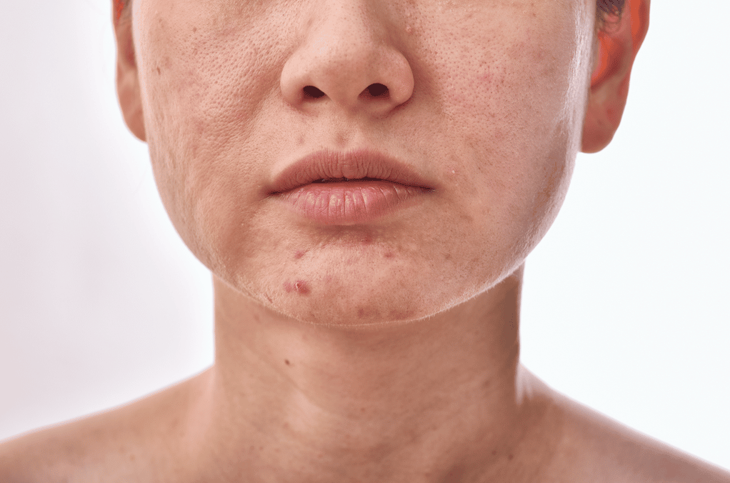 Does Medicare Cover Rosacea Treatment