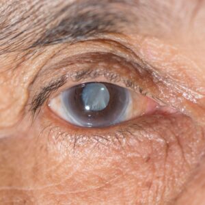 does Medicare cover cataract surgery