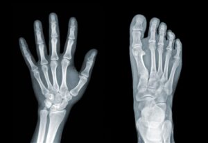 does Medicare cover screening DEXA scans