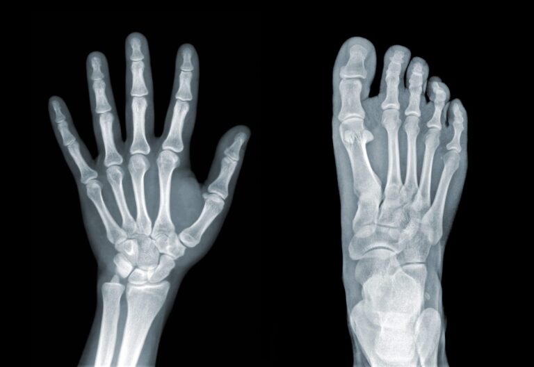 does Medicare cover screening DEXA scans