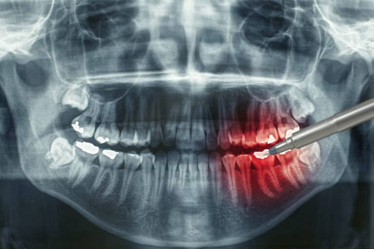 does Medicare cover tooth extractions