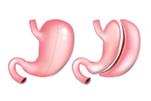 does medicare cover gastric sleeve revision